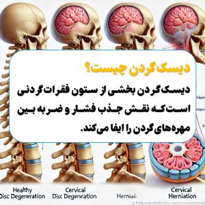 دیسک گردن چیست؟
