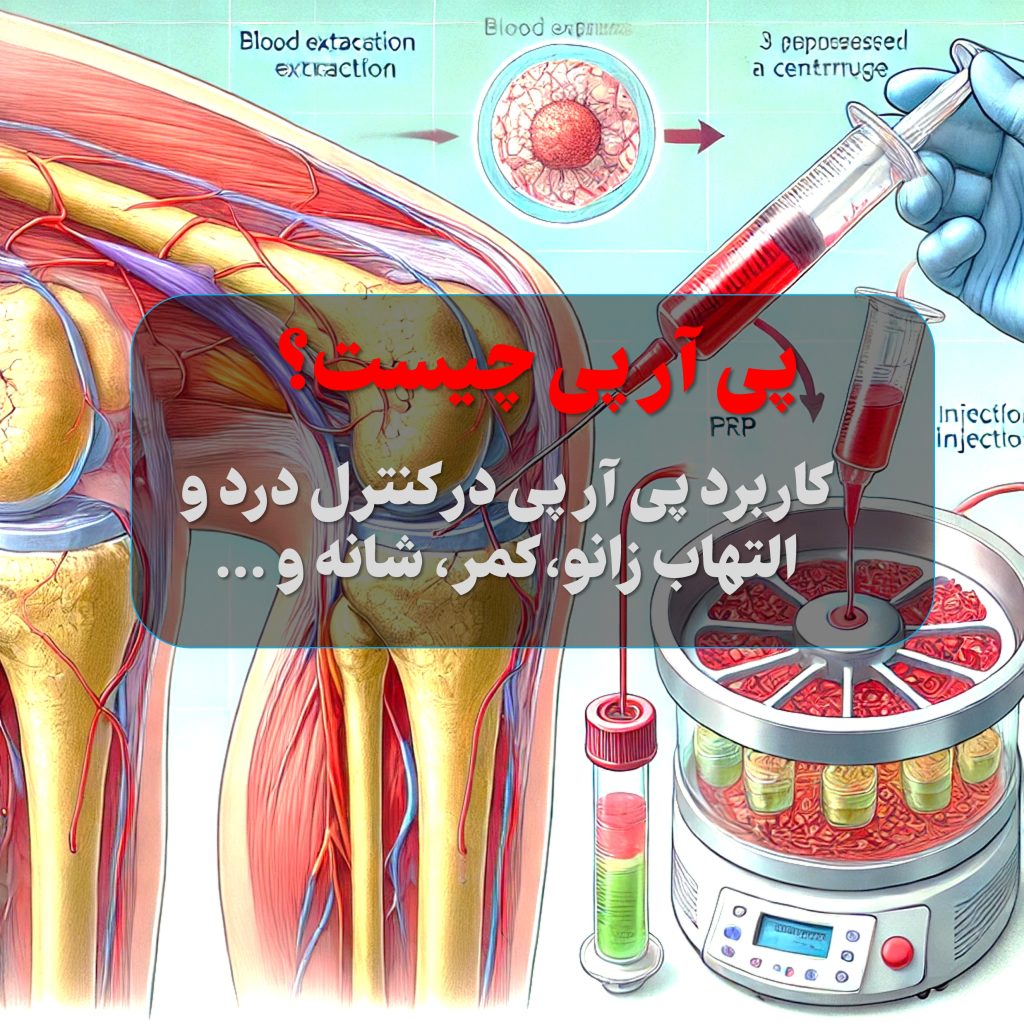 در این روش، مقدار مشخصی خون از خود بیمار گرفته می‌شود. سپس در دستگاه سانتریفیوژ، اجزای خون (گلبول‌های قرمز، گلبول‌های سفید و پلاکت‌ها) از هم جدا می‌شوند و پلاسما و پلاکت‌های غلیظ‌شده به‌دست می‌آیند که سرشار از فاکتورهای رشد هستند. این ترکیب نهایی که اصطلاحاً پی آر پی (Prp) نام دارد، مجدداً به زانوی بیمار تزریق می‌شود و با تسریع ترمیم بافت‌های غضروفی، تاندون‌ها و عضلات، به بهبود درد و التهاب کمک می‌کند.