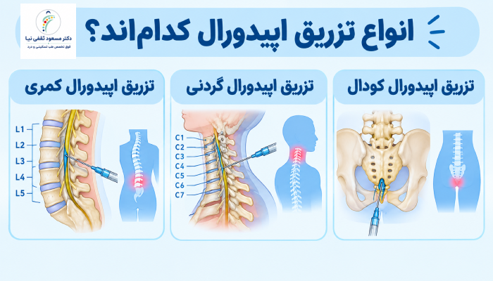 انواع تزریق اپیدورال کدام‌اند؟