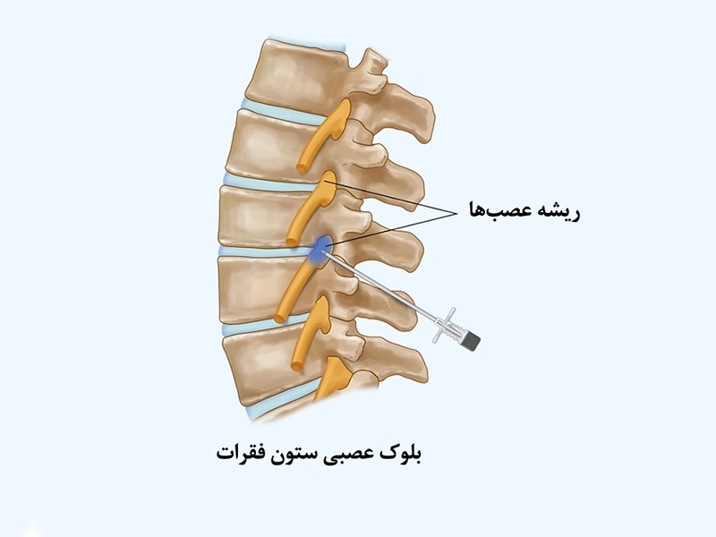 بلوک عصبی سیاتیک
